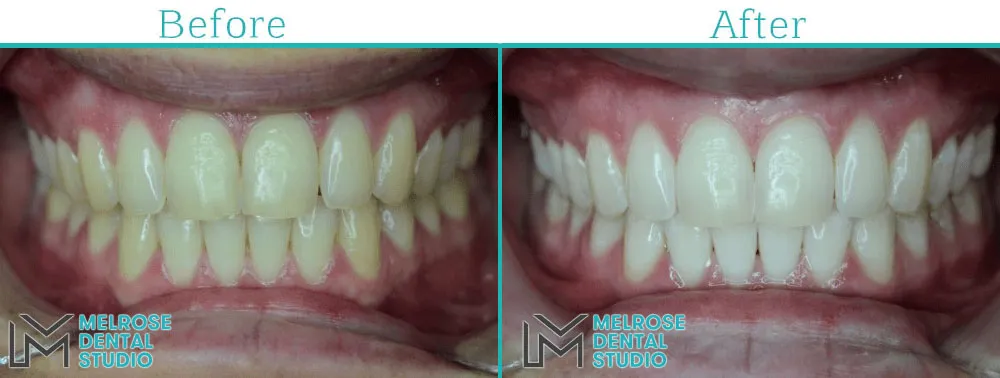Teeth whitening before and after result, case 3, Melrose Dental Studio